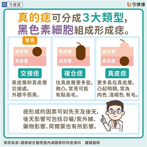 腋下旁邊有痣|是痣？還是皮膚癌？皮膚科醫師教你揪出「假的痣」，。